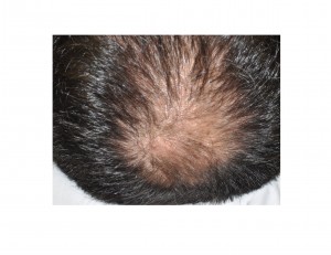 Scalp Scar from Male Forehead Augmentation Dr Barry Eppley Indianapolis