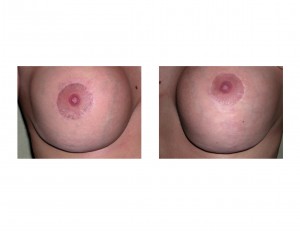 Vertical Breast Lift Scar Revisions Dr Barry Eppley Indianapolis