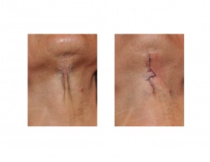 Z-plasty Neck Scar Dr Barry Eppley Indianapolis