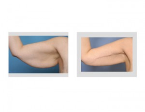 Armlift results (inner arm scar)