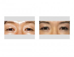 Asian Double Eyelid Surgery Dr Barry Eppley Indianapolis