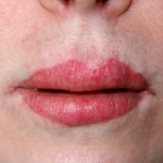 Bad Lip Advancement result
