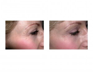 Botox for Crow's Feet Dr Barry Eppley Indianapolis