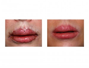 Early Lip Advancement Revision result Dr Barry Eppley Indianapolis