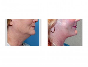 Facelift (Early Results) Dr Barry Eppley Indianapolis