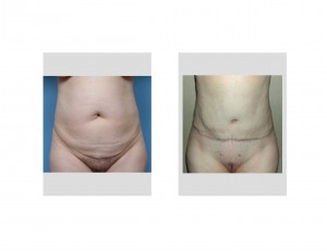 Full Tummy Tuck result front view Dr Barry Eppley Indianapolis