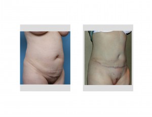 Full Tummy Tuck result oblique view Dr Barry Eppley Indianapolis