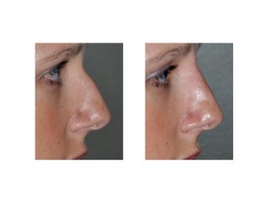 Injectable Rhinoplasty result Dr Barry Eppley Indianapolis