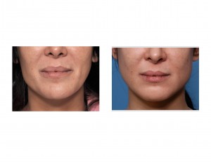 Jaw Angle Asymmetry Correction Dr Barry Eppley Indianapolis