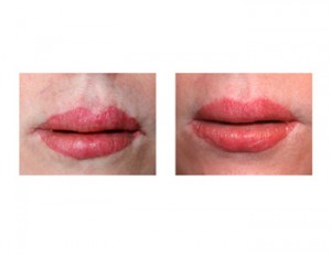 Lip Advancement Revision Surgery result Dr Barry Eppley Indianapolis