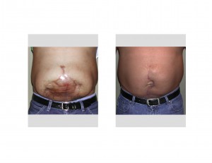 Mega Abdominal Scar Revision result front view Dr Barry Eppley Indianapolis