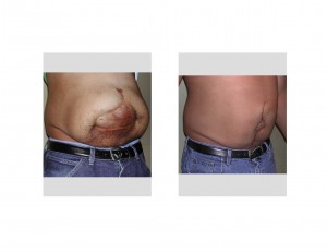 Mega Abdominal Scar Revision result oblique view Dr Barry Eppley Indianapolis