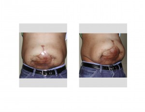 Mega Abdominal Scar before Dr Barry Eppley Indianapolis