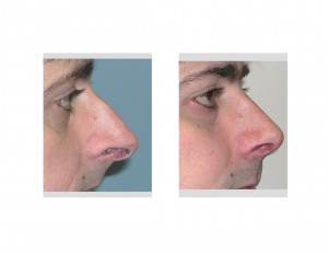 Overprojecting Nose Rhinoplasty Dr Barry Eppley Indianapolis