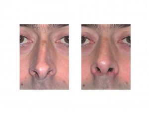 Overprojecting Nose Rhinoplasty result front view Dr Barry Eppley Indianapolis