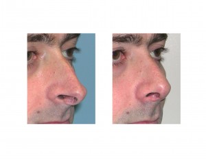 Overprojecting Nose Rhinoplasty result oblique view Dr Barry Eppley Indianapolis