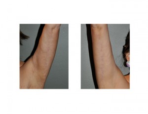 Posterior Armlift Scars Dr Barry Eppley Indianapolis
