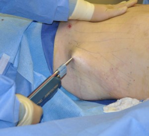 Power-Assisted Liposuction Indianapolis Dr Barry Eppley