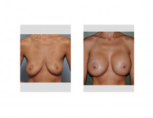 Shaped Implant Breast Augmentation results front view