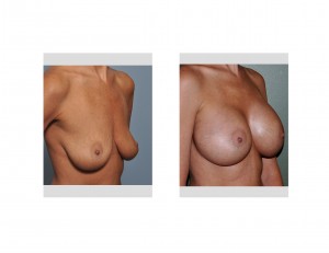 Shaped Implant Breast Augmentation results oblique view