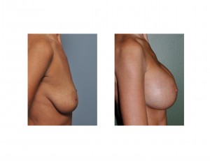 Shaped Implant Breast Augmentation results side view