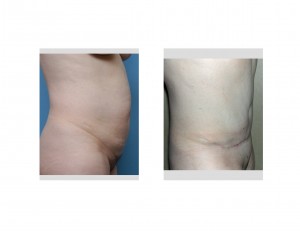 Tummy Tuck result side view Dr Barry Eppley Indianapolis