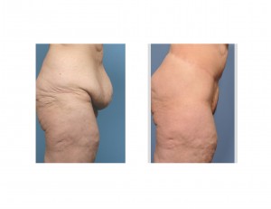 Body Lift after Gastric Bypass Dr Barry Eppley Indianapolis