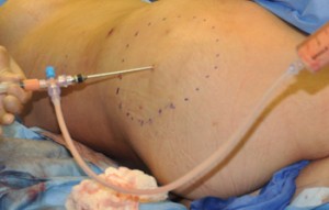 Buttock Fat Injections Dr Barry Eppley Indianapolis