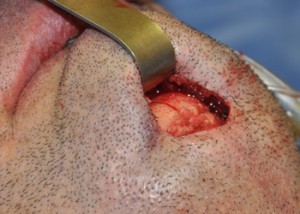 Chin Implant Imprinting Dr Barry Eppley Indianapolis