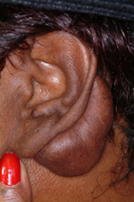 Ear Keloid Dr Barry Eppley Indianapolis