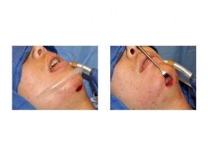 Female Jawline Implant Augmentationk during surgery Dr Barry Eppley Indianapolis
