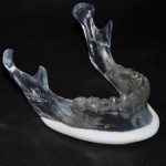 Female Jawline Implant Dr Barry Eppley Indianapolis