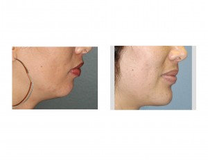 Female Jawline Implant result Dr Barry Eppley Indianapolis