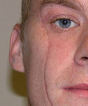 Hypertrophic (anti-RSTL) Scar Dr Barry Eppley Indianapolis