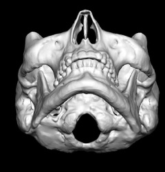 Jaw Angle Anatomy Dr Barry Eppley Indianapolis