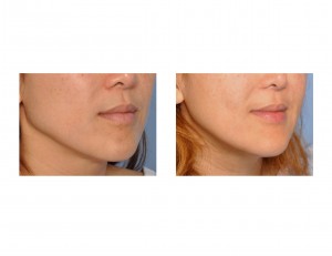 Jaw Angle Reduction result oblique view Dr Barry Eppleuy Indianapolis