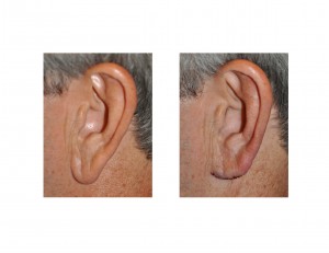 Left Earlobe Reduction Dr Barry Eppley
