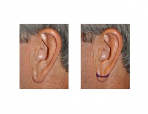 Left Earlobe markings before surgery Dr Barry Eppley Indianapolis