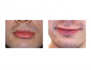 Lower Lip Vermilion Asymmetry Dr Barry Eppley Indianapolis