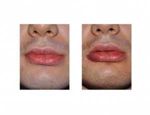 Partial Lower Lip Advancement Dr Barry Eppley Indianapolis