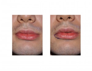 Partial Lower Lip Advancement for Asymmetry Dr Barry Eppley Indianapolis