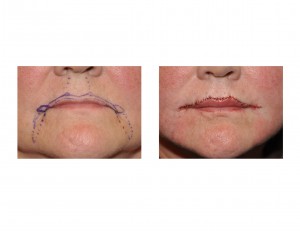 R Lip Rejuvenation Surgery