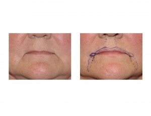 R Lip Rejuvenation plan