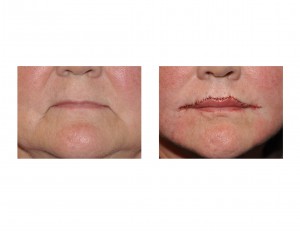 RLip[ Advacnement, COM and Fat Injections result