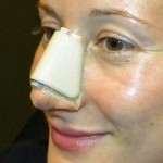 Rhinoplasty (Nasal Splint) Dr Barry Eppley Indianapolis