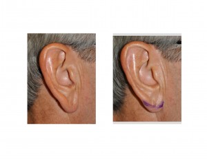 Right Earlobe Markings Dr Barry Eppley Indianapolis
