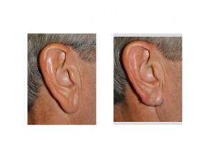 Right Earlobe Reduction Dr Barry Eppley Indianapolis