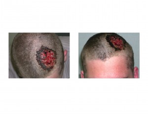 Scalp Avulsion Dr Barry Eppley Indianapolis