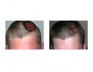 Scalp Reconstruction Dr Barry Eppley Indianapolis