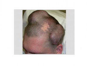 Scalp Tissue Expanders Dr Barry Eppley Indianapolis